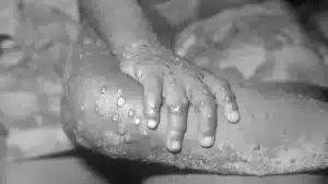 La viruela del mono nos recuerda la necesidad de contar con los veterinarios.